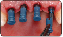 4. Snap a 2.0mm plastic impression sleeve onto a corresponding 2.0mm titanium impression post.